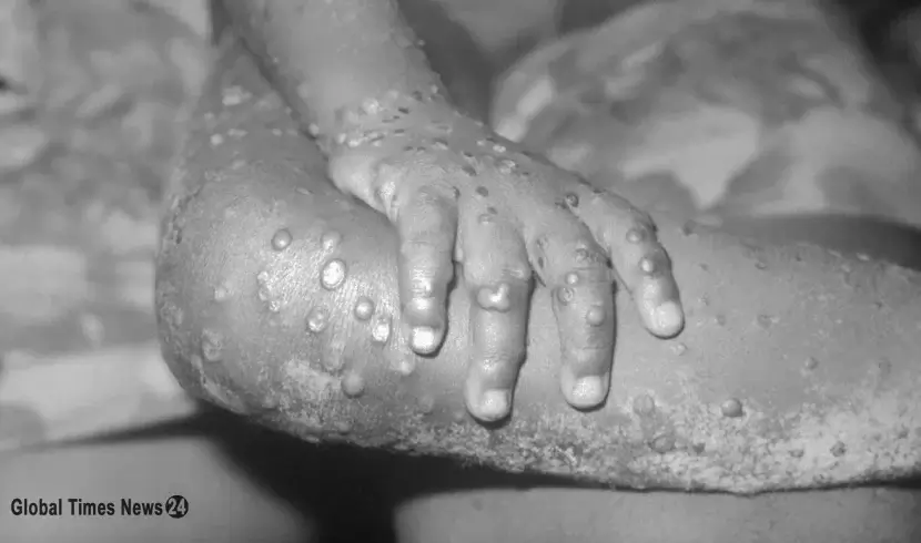After US & Europe, monkeypox spreads to Israel