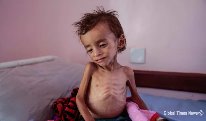 Yémen : éclipsé par l'Ukraine, le pays laissé seul face à la famine