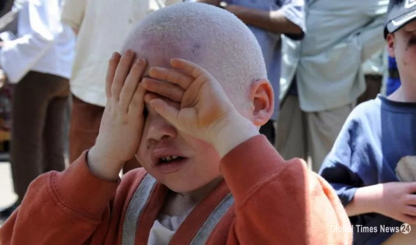RDC : le corps d’un petit garçon albinos retrouvé sans tête ni jambes le lendemain de son enlèvement